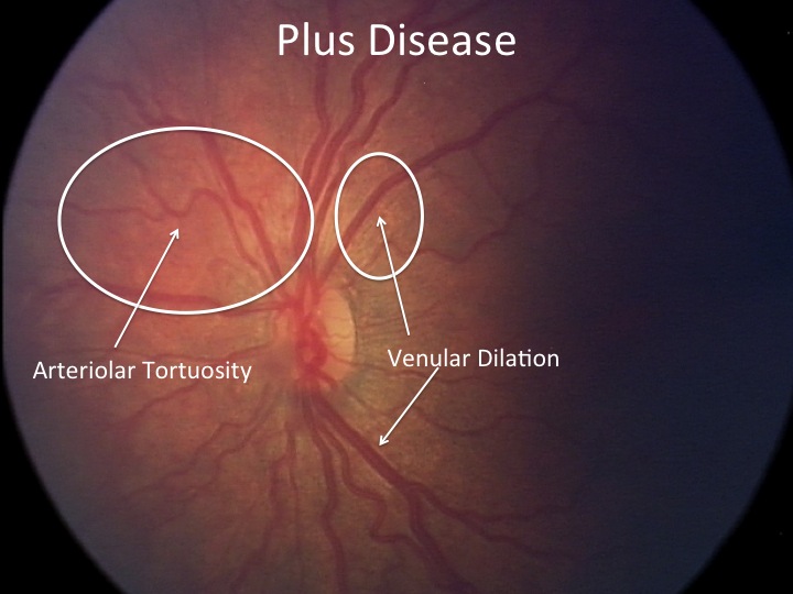 retinopathy of prematurity plus disease